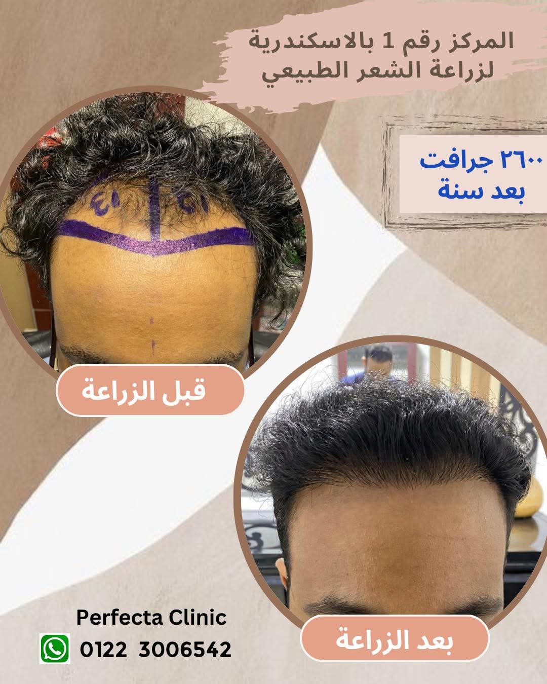 حالة زراعة شعر قبل وبعد
