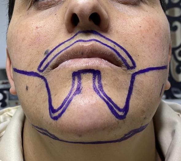 نتيجة زراعة اللحية 2