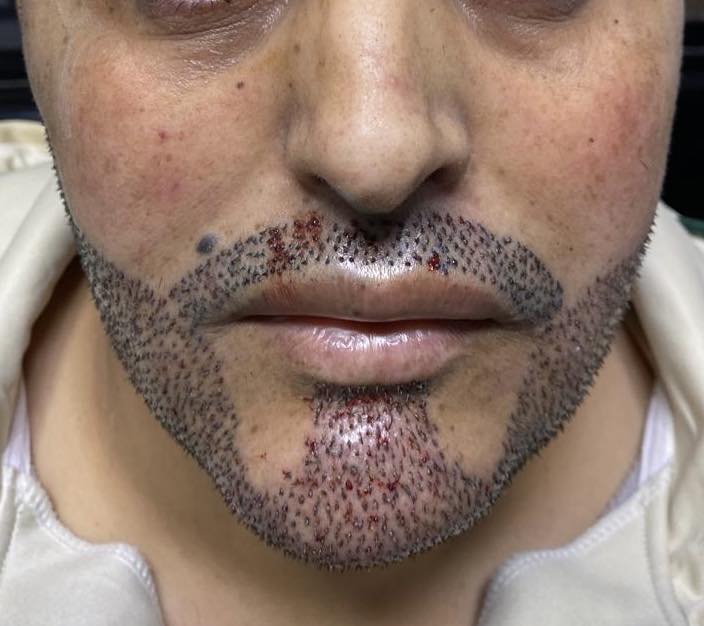 نتيجة زراعة اللحية 1
