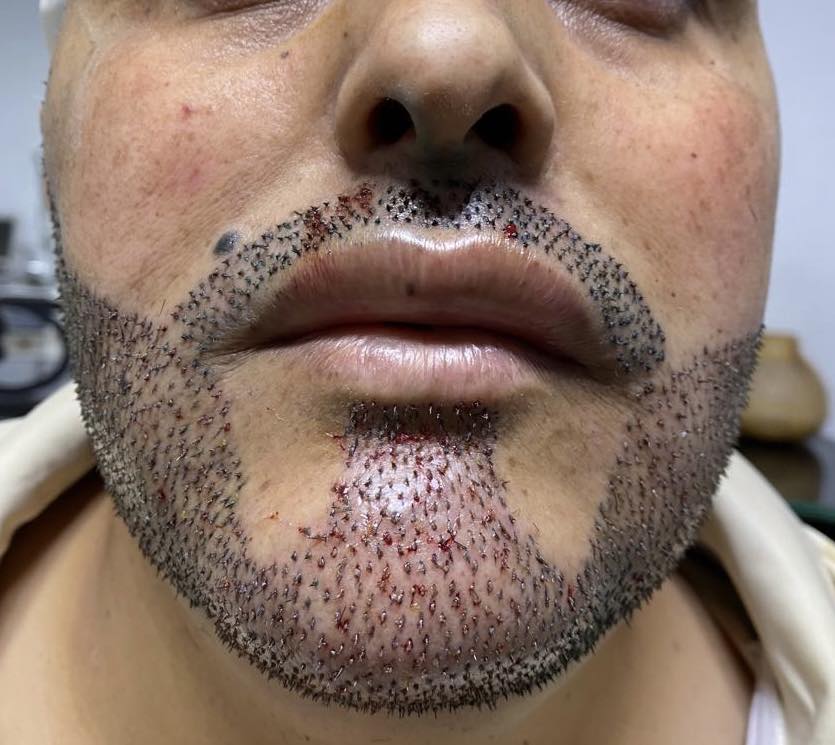 نتيجة زراعة اللحية 3