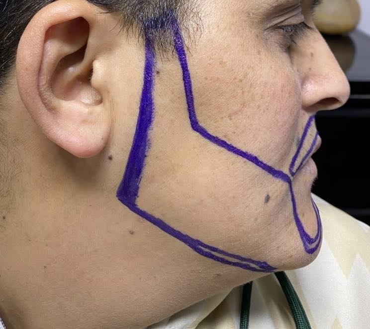 نتيجة زراعة اللحية 4