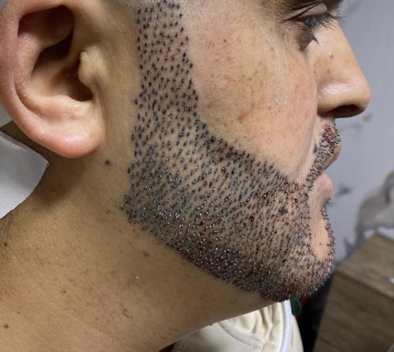 نتيجة زراعة اللحية 5