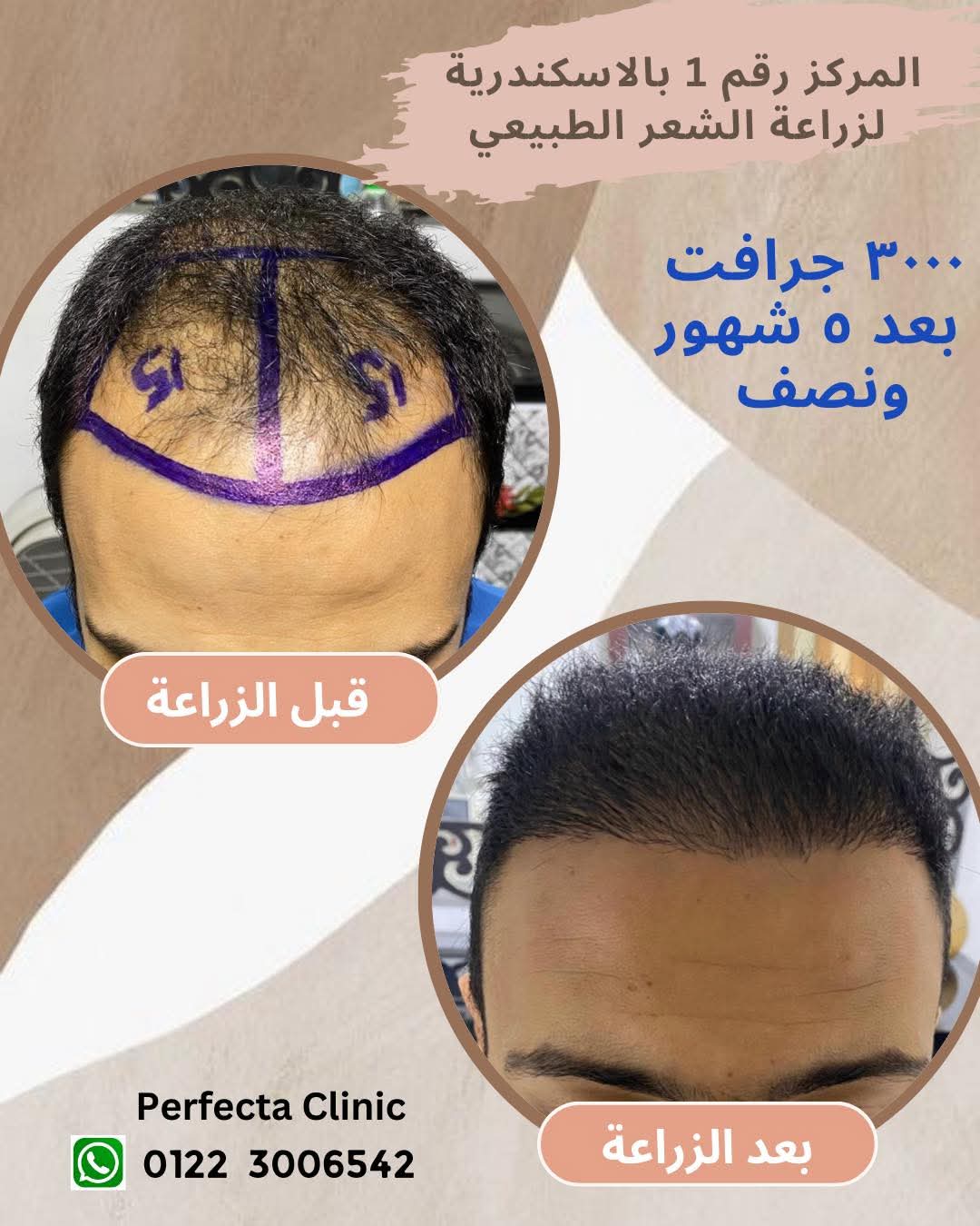 حالة زراعة شعر قبل وبعد