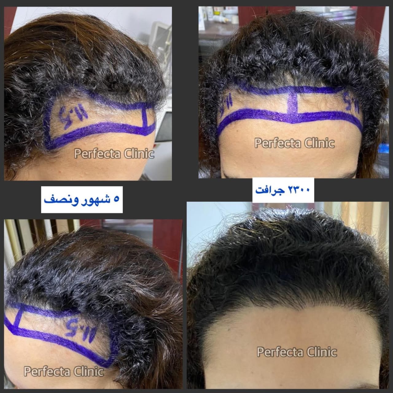 رسم خط الشعر الأمامي