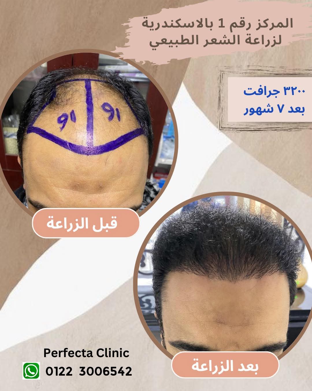 حالة زراعة شعر قبل وبعد