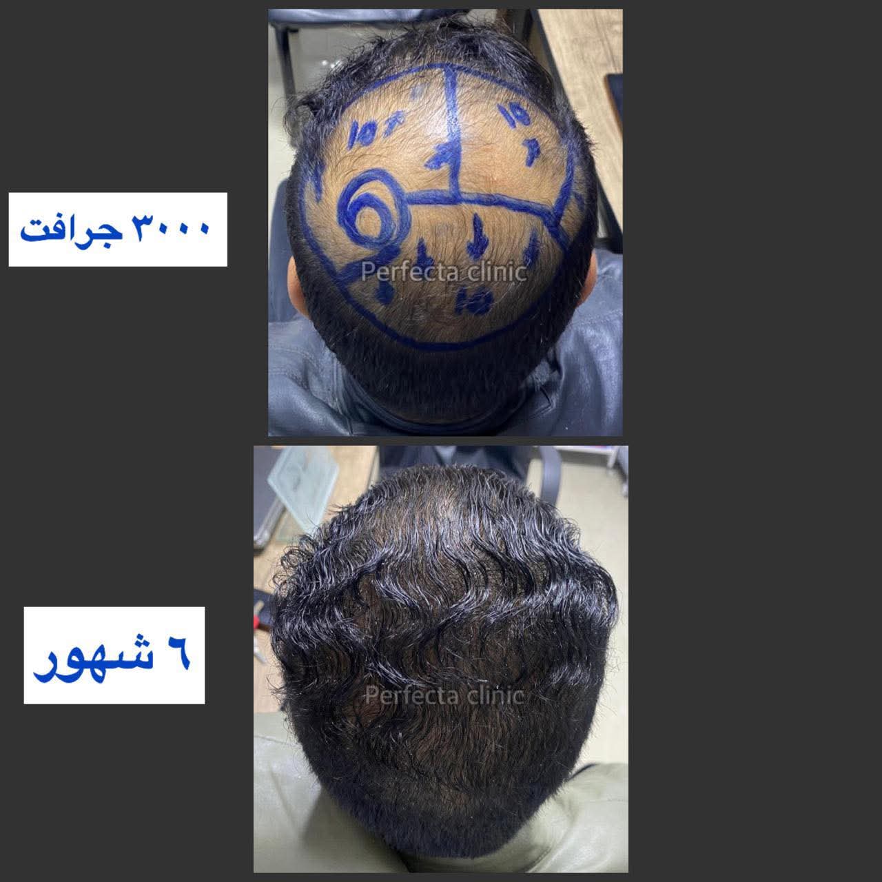 كثافة الشعر بعد الزراعة