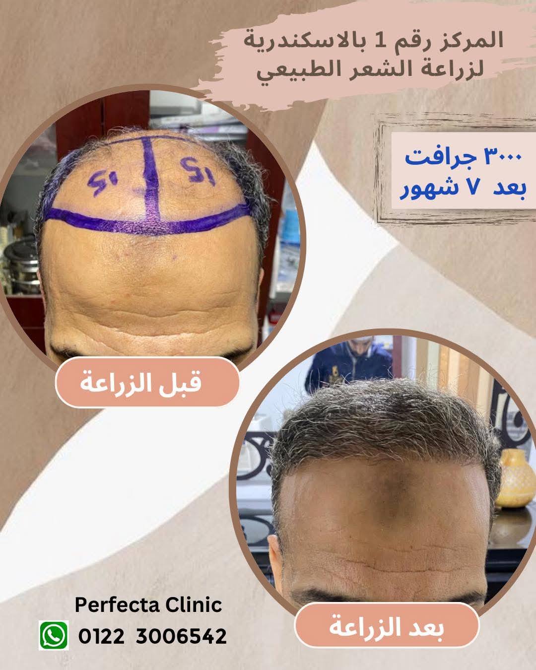 حالة زراعة شعر قبل وبعد