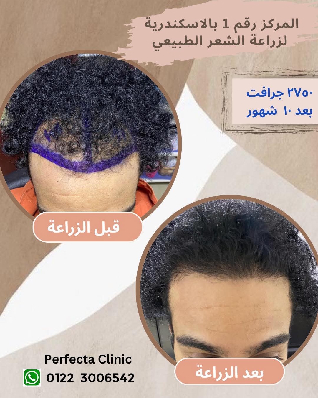 حالة زراعة شعر قبل وبعد