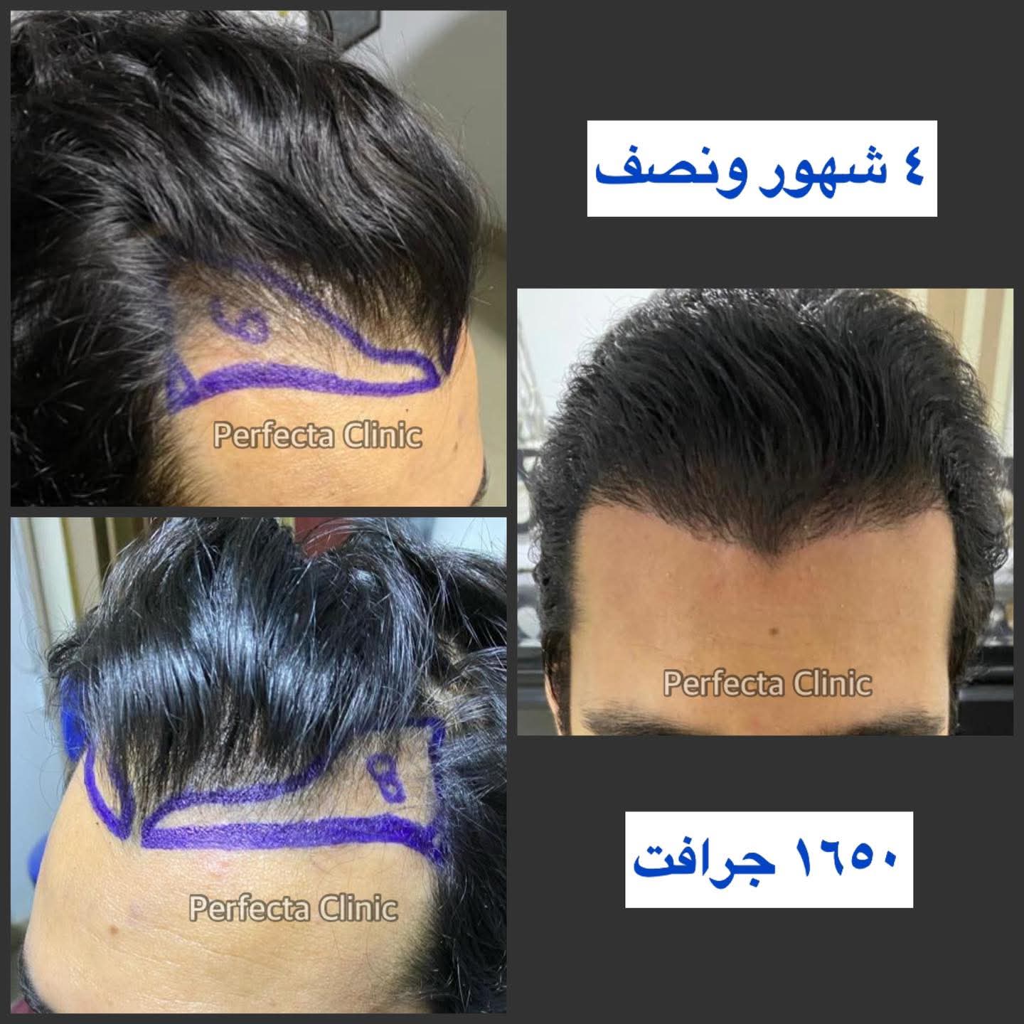نتيجة زراعة شعر طبيعي