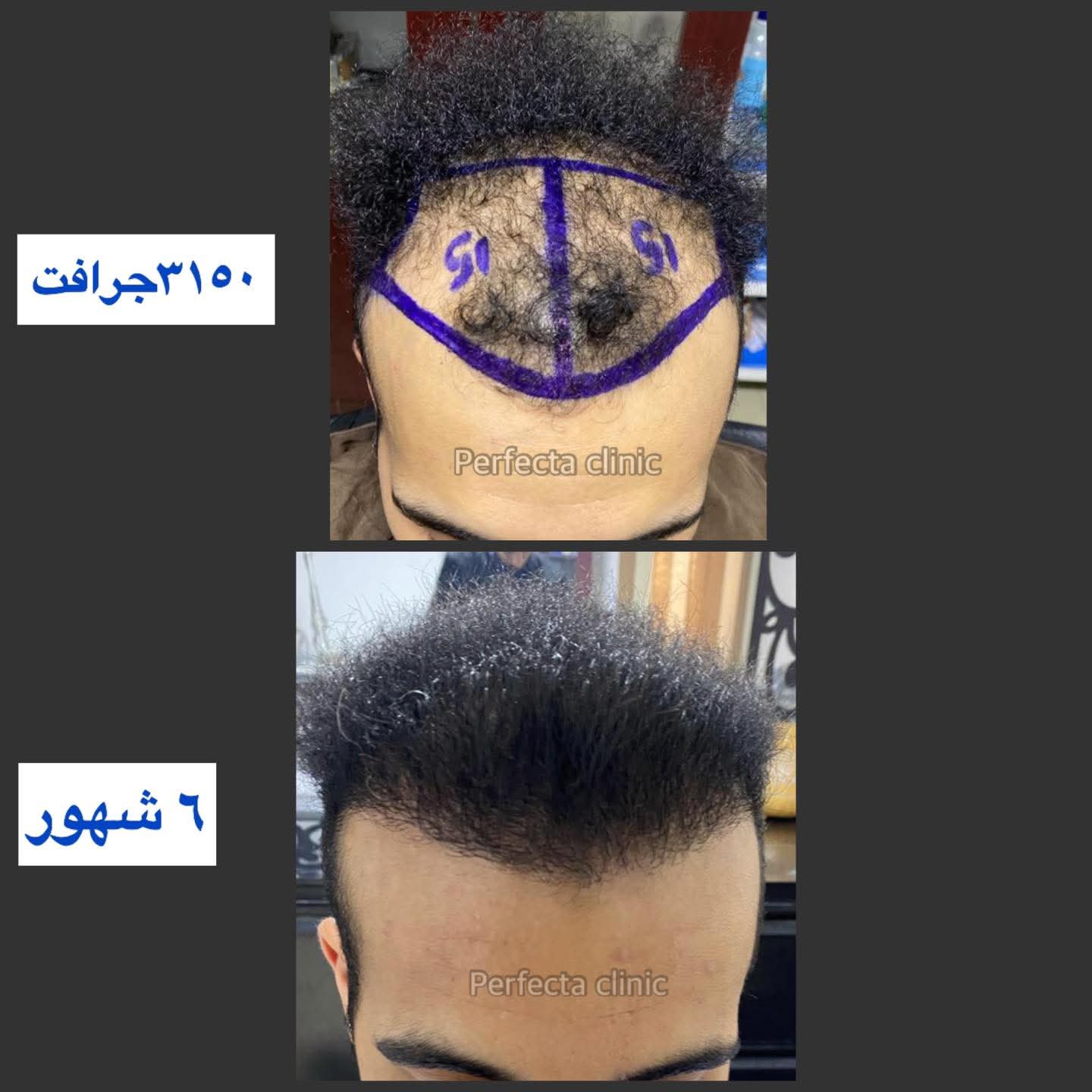 قبل وبعد زراعة الشعر