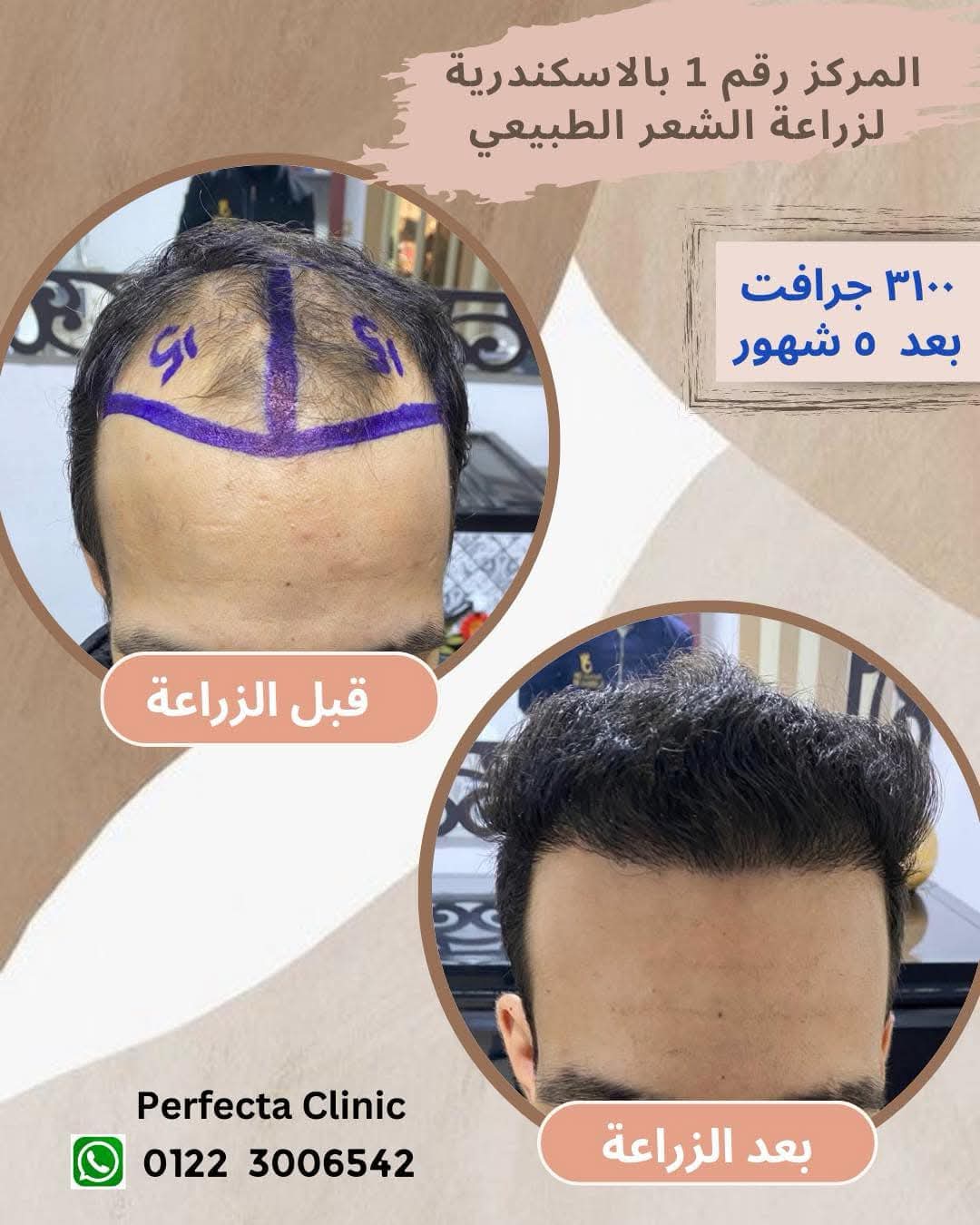 حالة زراعة شعر قبل وبعد