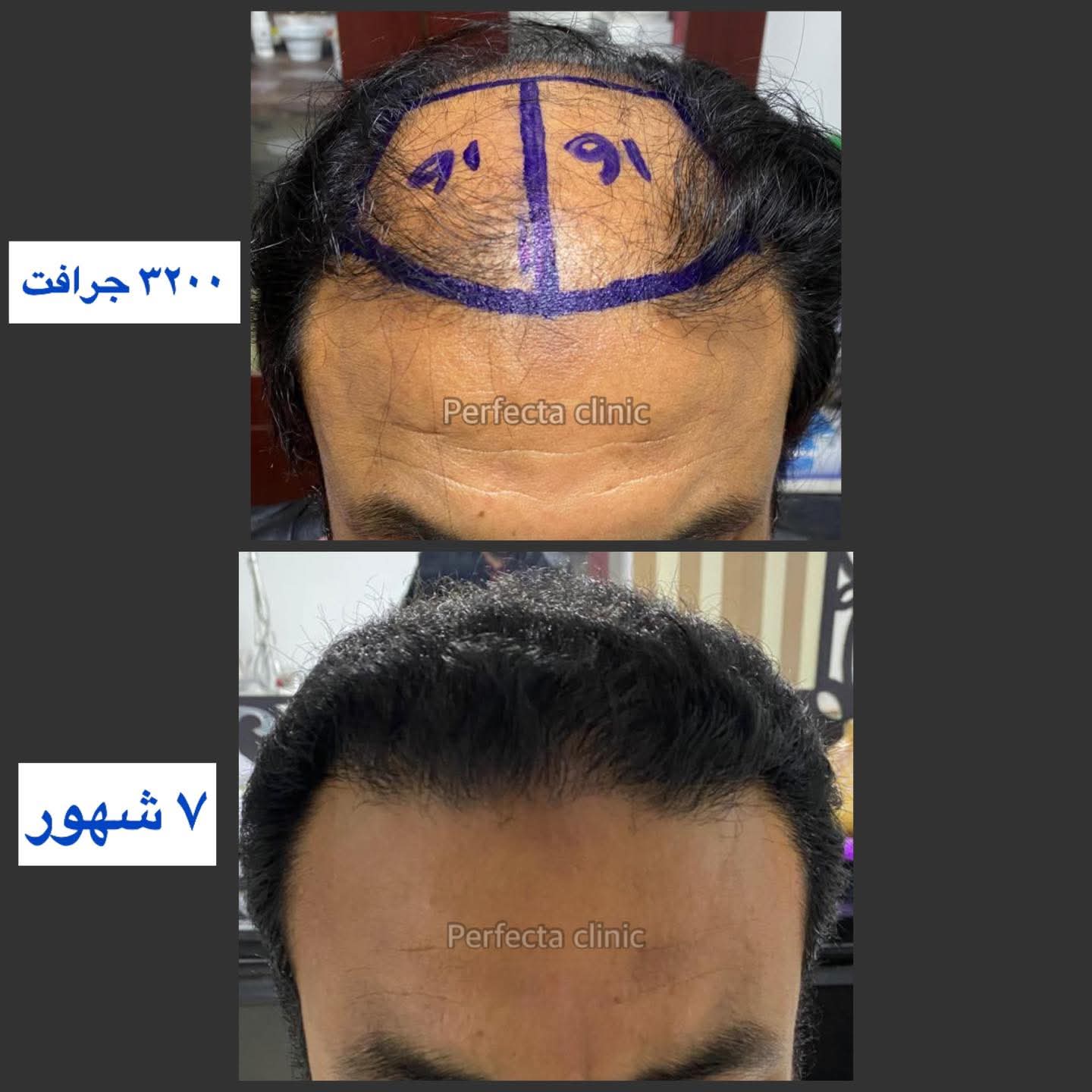 حالة زراعة شعر قبل وبعد