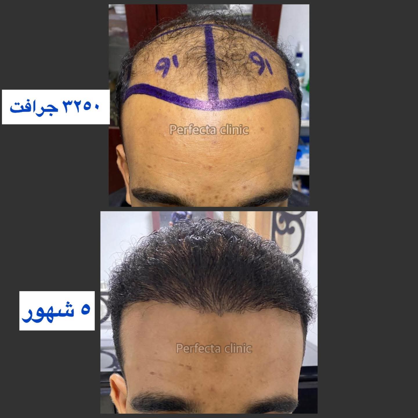 حالة زراعة شعر قبل وبعد